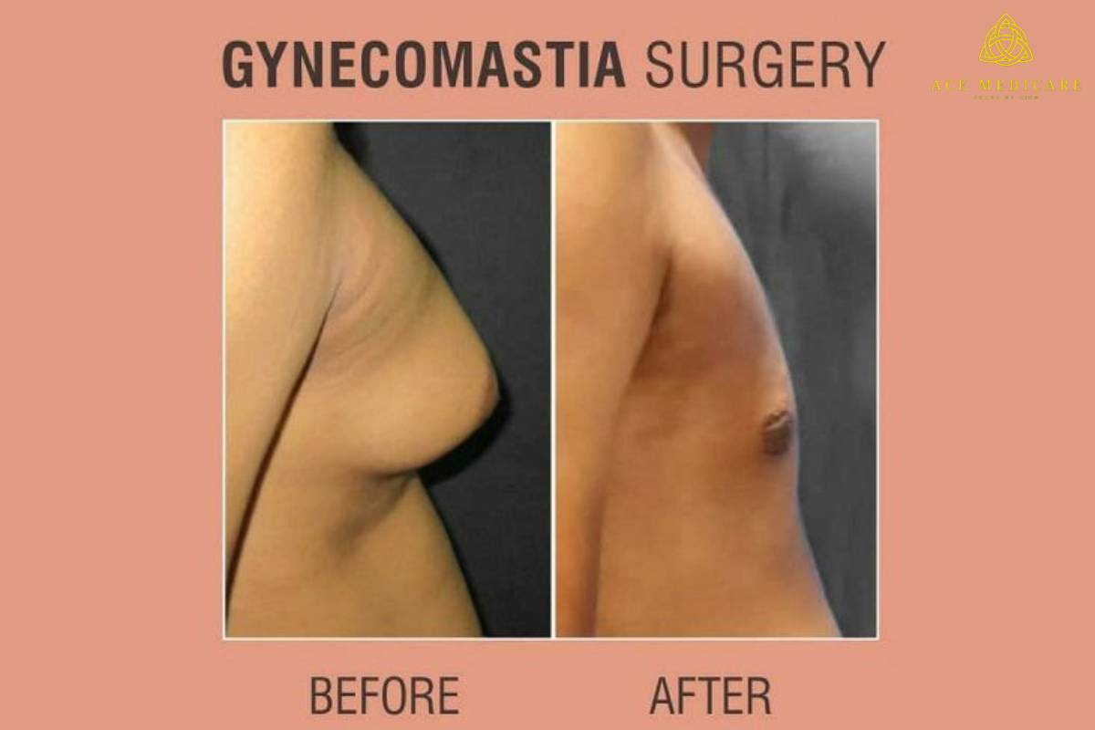 Gynecomastia Surgery: What You Need to Know